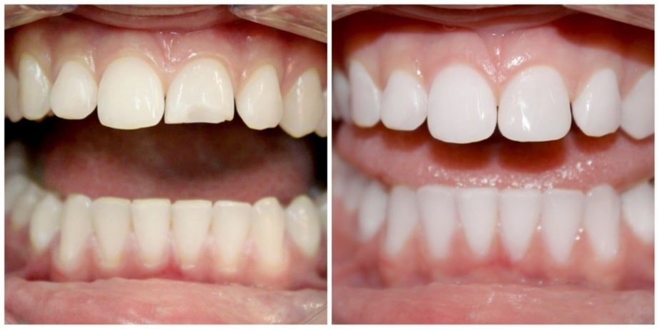 Восстановление сколов зубов