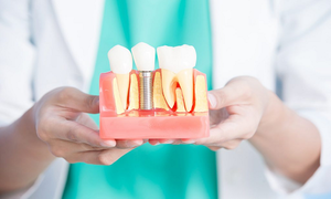 5 вопросов стоматологу об имплантации зубов