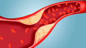 Как понизить холестерин в крови?