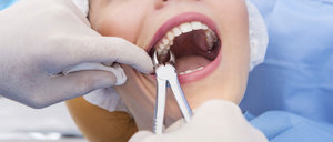 Удаление зубов в Череповце
