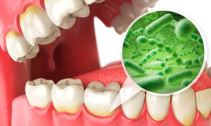 Зубной налет: причины, симптомы и лечение.