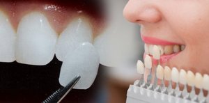 В стоматологии «Люкс Дент» весь декабрь действует скидка на профессиональную гигиену и отбеливание!