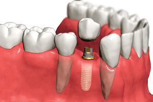 Поставить зубные импланты
