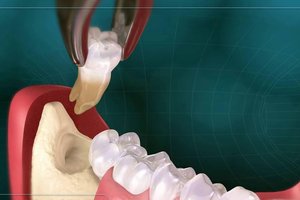 Удаление зуба мудрости: причины, последствия, цена операции