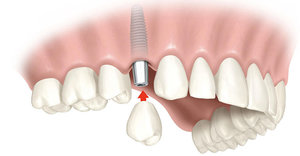 Установить зубные импланты в Череповце