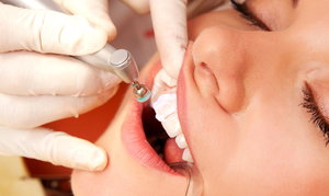 Записаться на процедуру удаления зубного камня